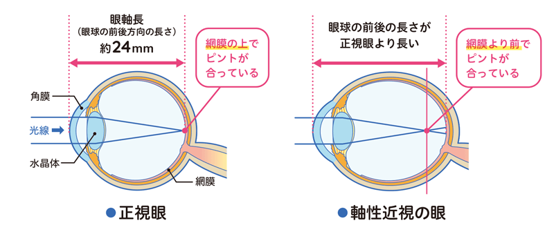 近視とは