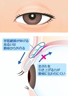 眼瞼下垂の目